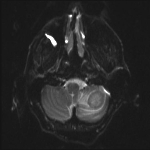 Fil:Tumor dwi.jpg